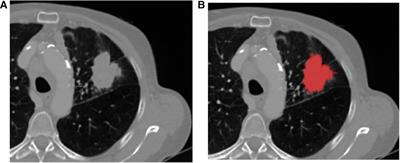 Radiomics combined with transcriptomics to predict response to immunotherapy from patients treated with PD-1/PD-L1 inhibitors for advanced NSCLC